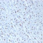 FFPE human mesothelioma sections stained with 100 ul anti-Wilms Tumor 1 (clone WT1/857 + 6F-H2) at 1:50. HIER epitope retrieval prior to staining was performed in 10mM Citrate, pH 6.0.